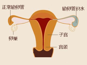 输卵管积水有什么治疗方法